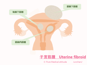子宮筋腫　Uterine fibroid　１