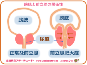 膀胱と前立腺の関係性（前立腺肥大症）