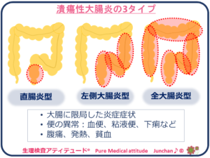 潰瘍性大腸炎の3つのタイプ