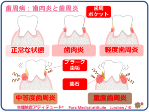 歯周病：歯肉炎と歯周炎